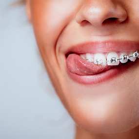 Знижка 250 грн на професійну чистку зубів ультразвуком та Air-Flow від стоматологічної клініки «Stomaline» -111785218